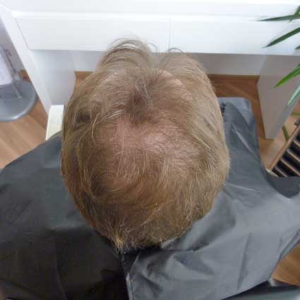 SensiHair Vergleich: Oberkopf vorher