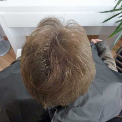 SensiHair Vergleich: Oberkopf nachher