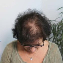 SensiHair Vergleich: Oberkopf Frau vorher