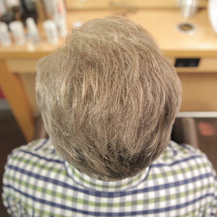 SensiHair Vergleich: Oberkopf Mann vorher